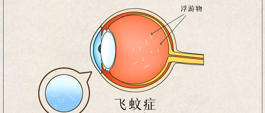 飞向光明：战胜飞蚊症的先进治疗方法 眼睛干涩 眼睛疲劳 眼压高 近视 散光 眼疾